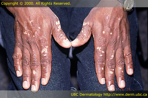 Vitiligo