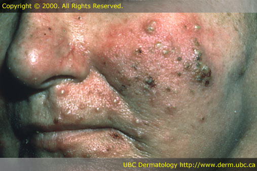 rosacea #10