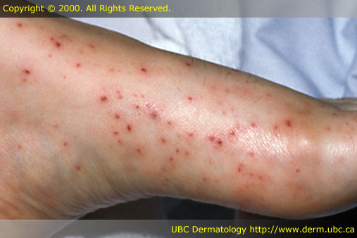 dermatologic conditions