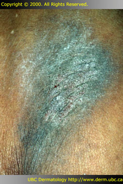 Lichen simplex chronicus