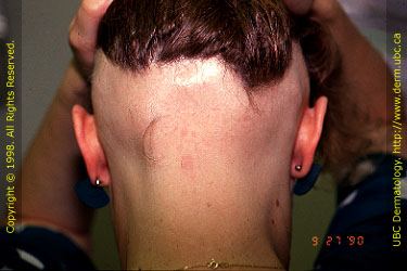 Alopecia Areata: Ophiasis type