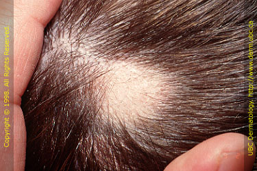 Topical steroid treatment for hair loss