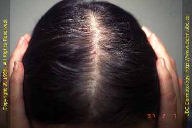 Pattern hair loss - Wikipedia