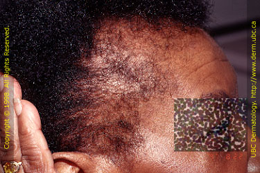 Traction Alopecia