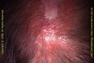 Discoid lupus of the scalp