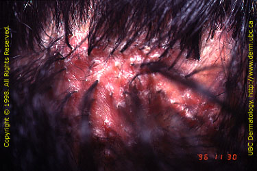 Folliculitis decalvans