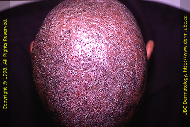 Scalp Acne - Acne.org