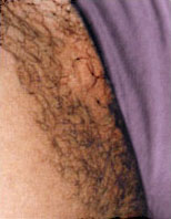 Bikini line before. Courtesy of Mark S. Nestor, MD, PhD.