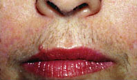 Upper lip before. Courtesy of Mark S. Nestor, MD, PhD.