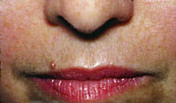 Upper lip after. Courtesy of Mark S. Nestor, MD, PhD.