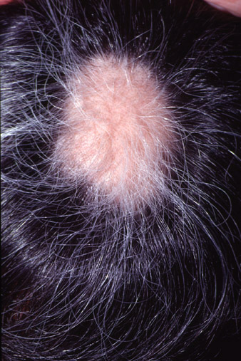 Circumscript Alopecia areata (AA)