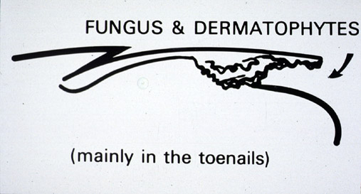 Fungus and Dermatophytes