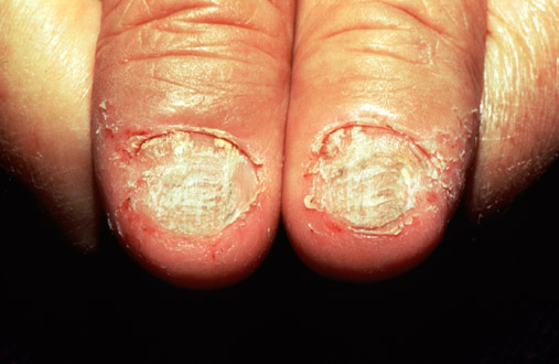 Psoriasis of the nails