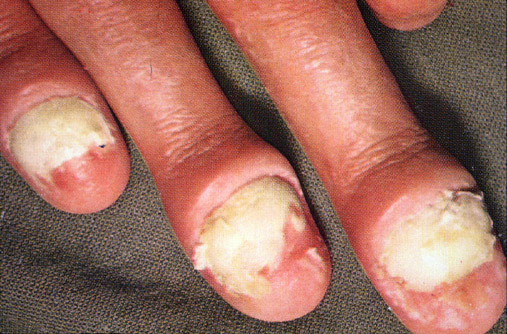 Psoriasis of the nails