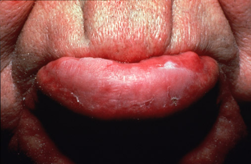 Leukoplakia