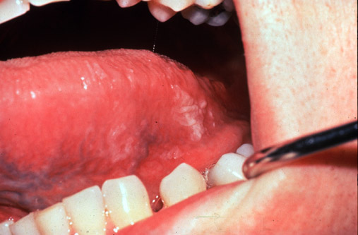 Oral hairy leukoplakia