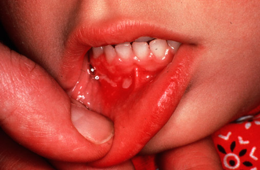 Herpes simplex