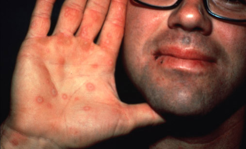 Erythema multiforme