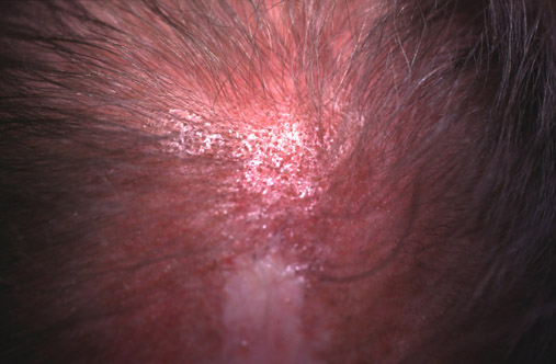 discoid lupus scalp