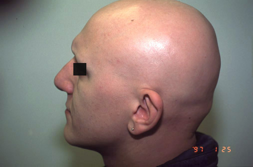 Alopecia universalis