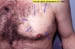 Alopecia areata (AA)