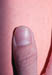 Nail pitting of psoriasis