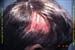 Tinea capitis
