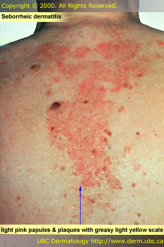chronic spongiotic dermatitis #11