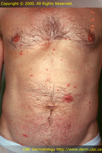 Pityriasis rosea