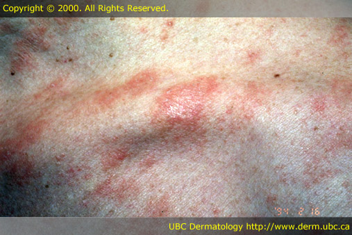 Pityriasis Rosea Symptoms, Treatments, Causes - WebMD