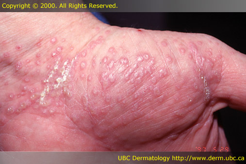 oral lichen planus photo