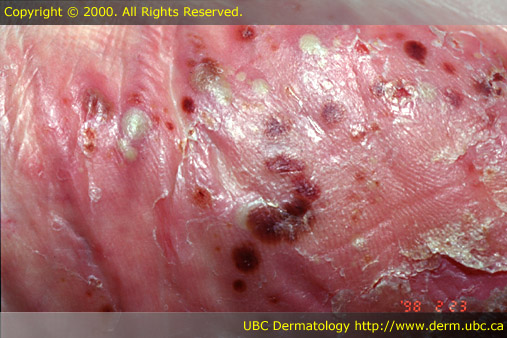Psoriasis