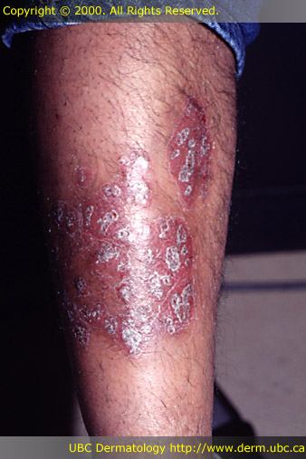 Psoriasis