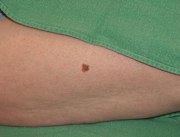 Melanoma Image 10A - Medium