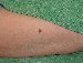 Melanoma Image 10A - Small