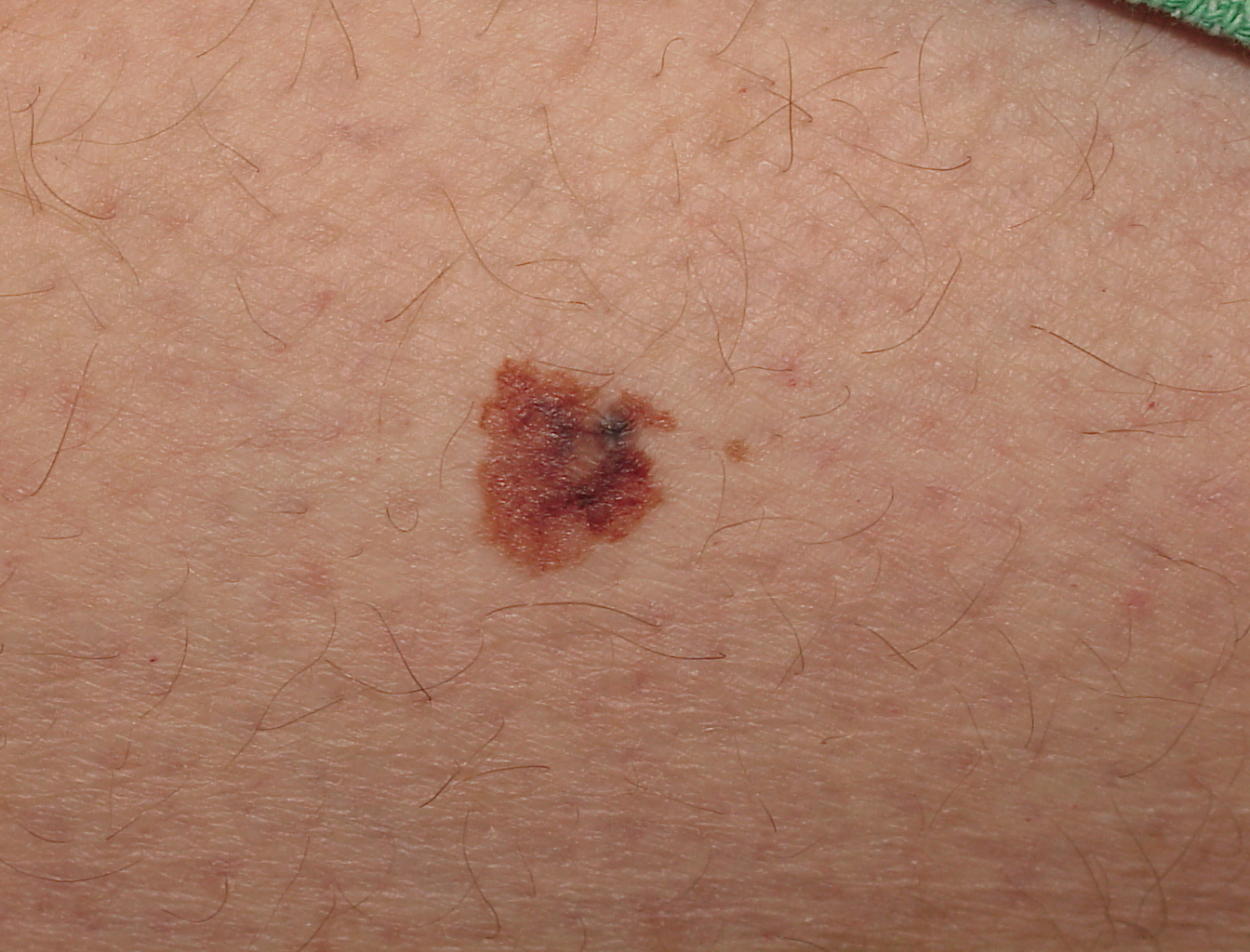 Melanoma pictures – Mole bank | SkinVision