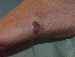 Melanoma Image 12 - Small