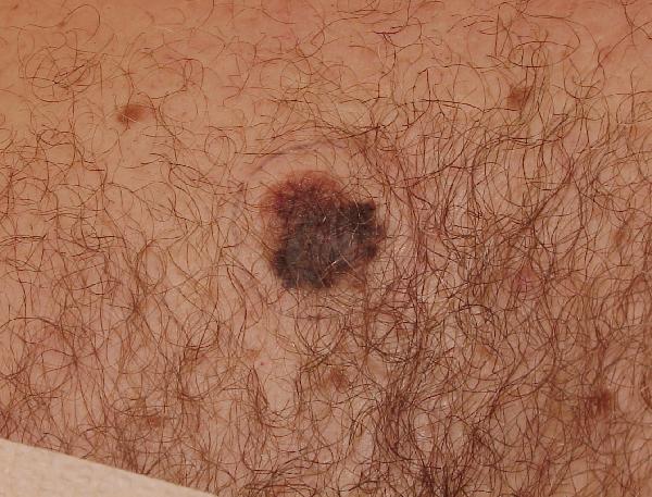 Melanoma Image 13 - Medium