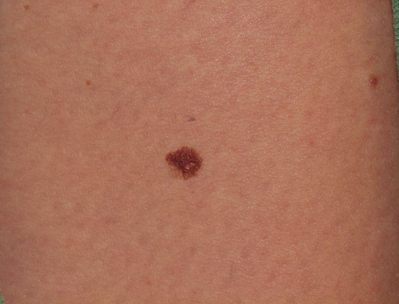 Melanoma Skin Cancer