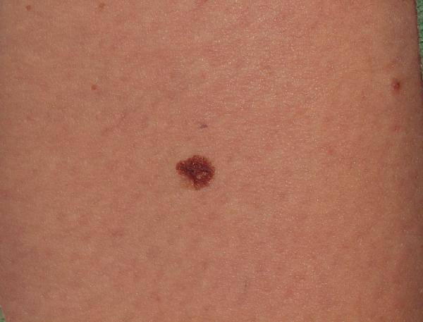 Melanoma Image 15 - Medium