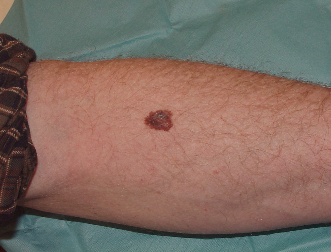 Melanoma Image 16A - Large