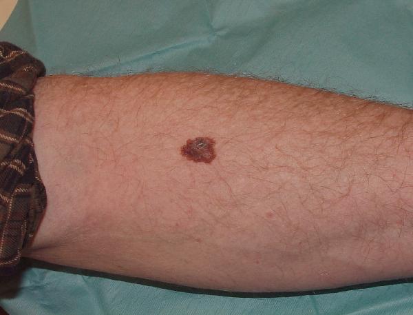 Melanoma Image 16A - Medium