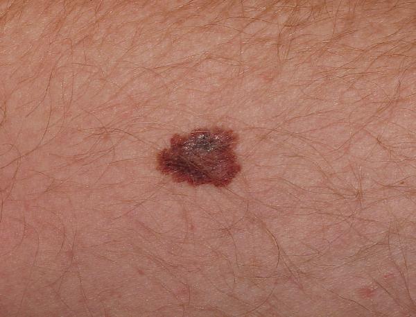 Melanoma Image 16B - Medium