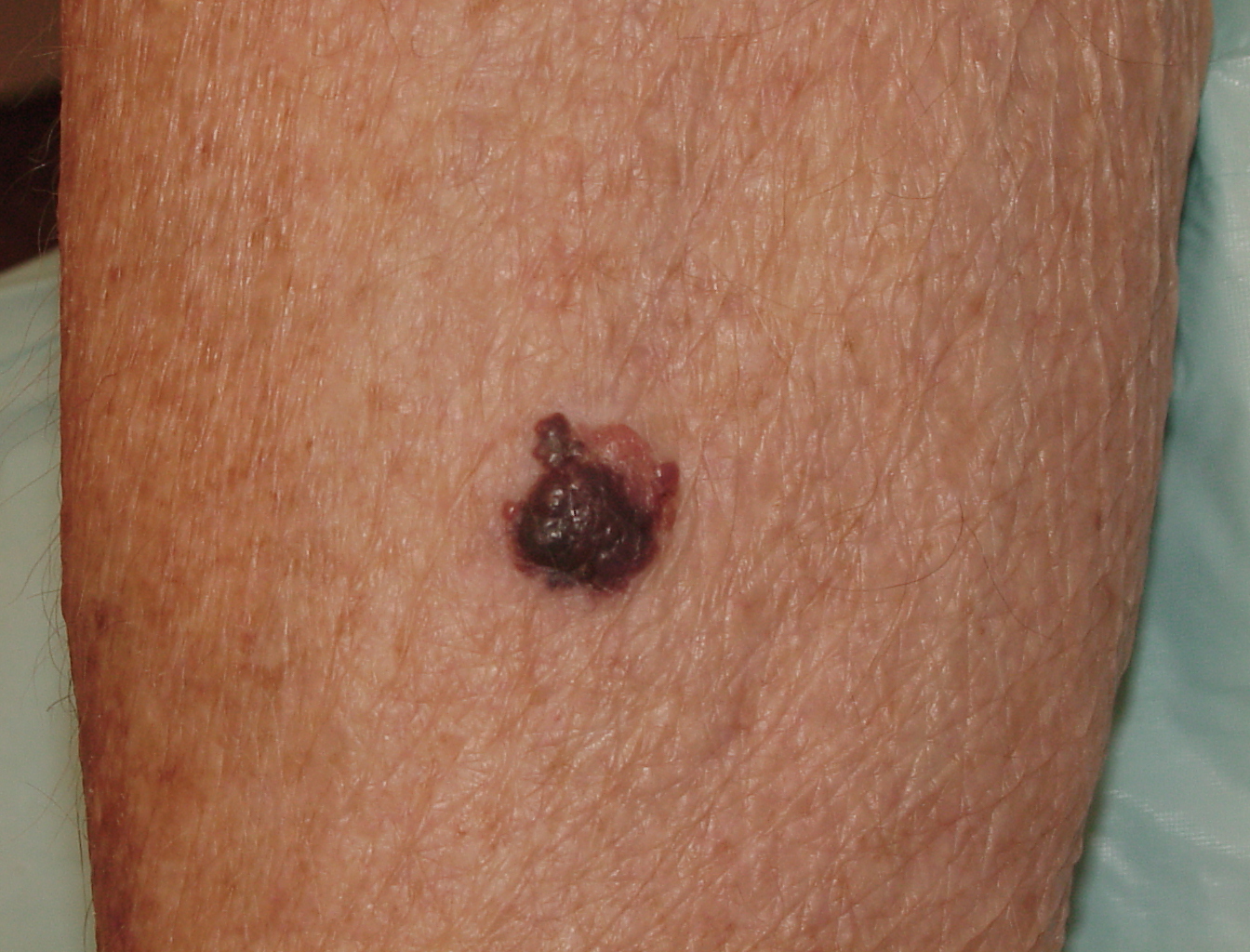 Melanoma Image 17 - Large