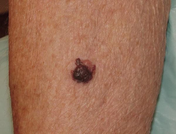 Melanoma Image 17 - Medium