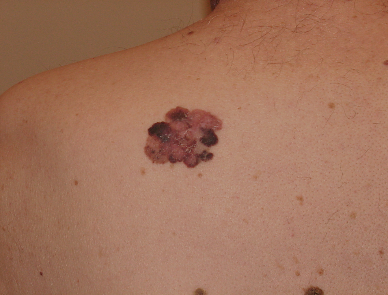 Melanoma Image 19A - Large