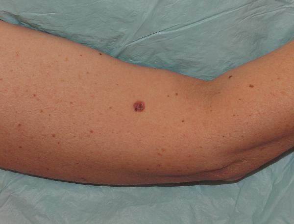 Melanoma Image 1A - Medium