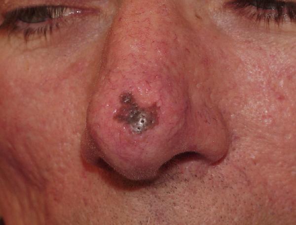 Melanoma Image 2 - Medium