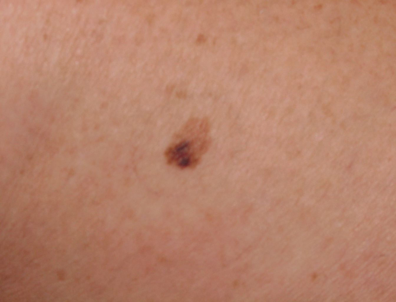 small melanoma - pictures, photos