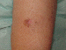 Melanoma Image 4 - Small